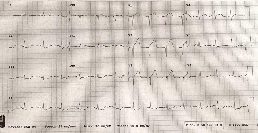An ECG demonstrates the extensive antero-septal-lateral myocardial infarction [heart attack] that Taryn witnessed.