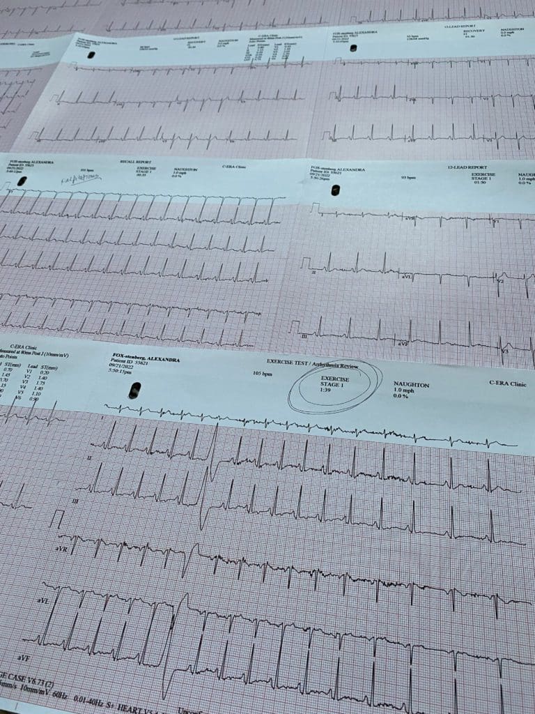 An ECGs printout from a treadmill stress test. The ECG in the forefront depicts an actual from a classmate PVC during exercise test.