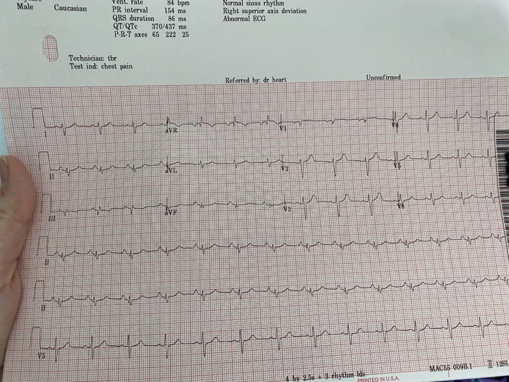 Taryn interpreting abnormal ECG